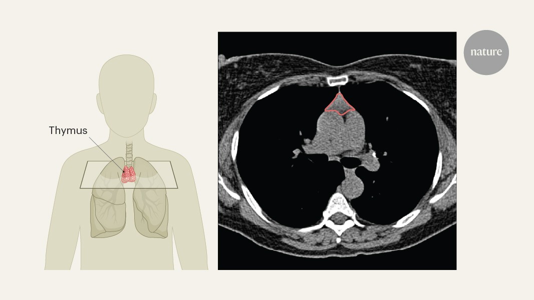 Thymus health is a predictor of lifelong well-being and immunotherapy effectiveness