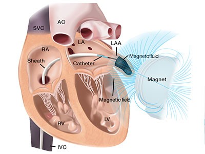 Magnetic gel injected into the heart could stop strokes