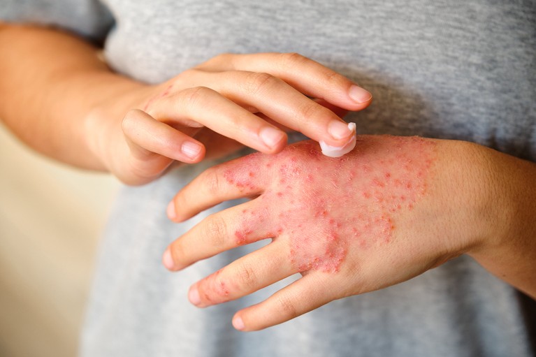 Stress can cause eczema to flare-up – now we know why