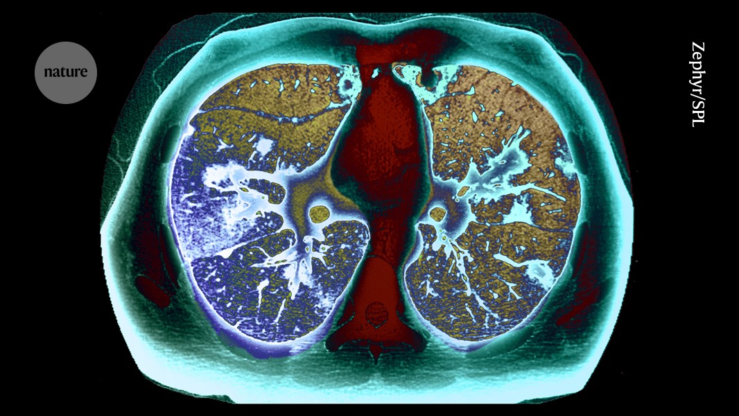 Huge lung-cancer screening campaign boosts early diagnosis