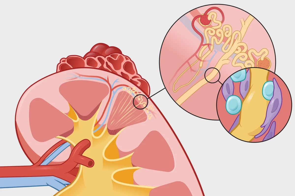 Why there is a distressing rise in kidney disease