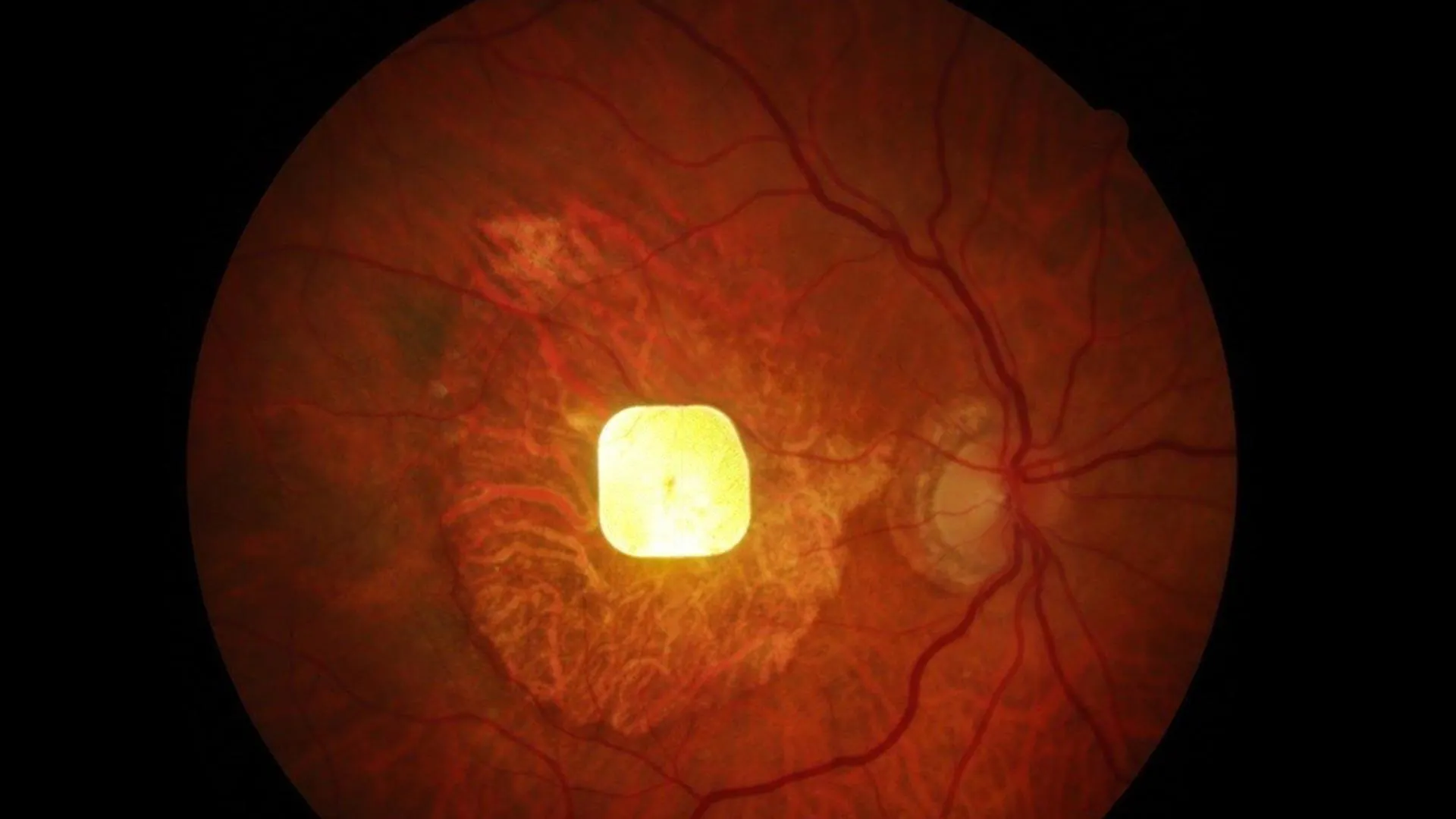 Wireless retinal implant helps blind patients see again