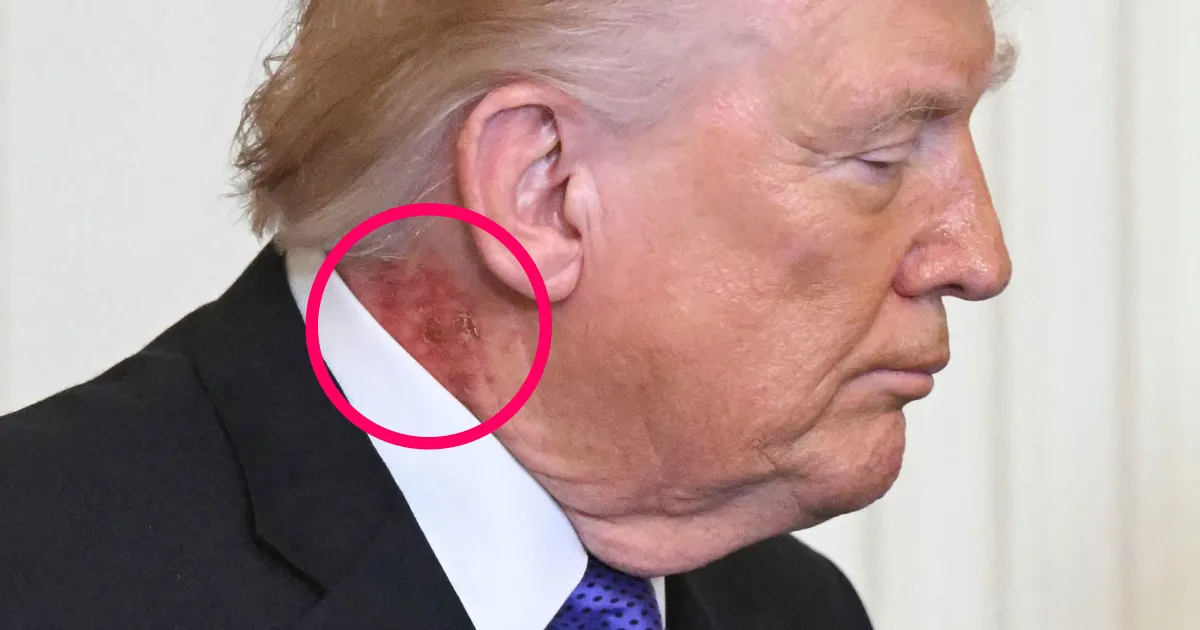 White House Responds as Scabby Mark Appears on Trump’s Neck