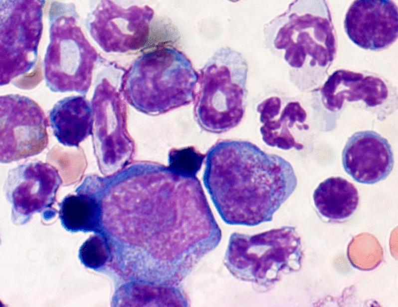 Site-specific methylation of SRSF2P95H by SETD2 inhibits MDSC-mediated proinflammatory niche formation in mouse models of myelodysplastic syndrome | Science Translational Medicine