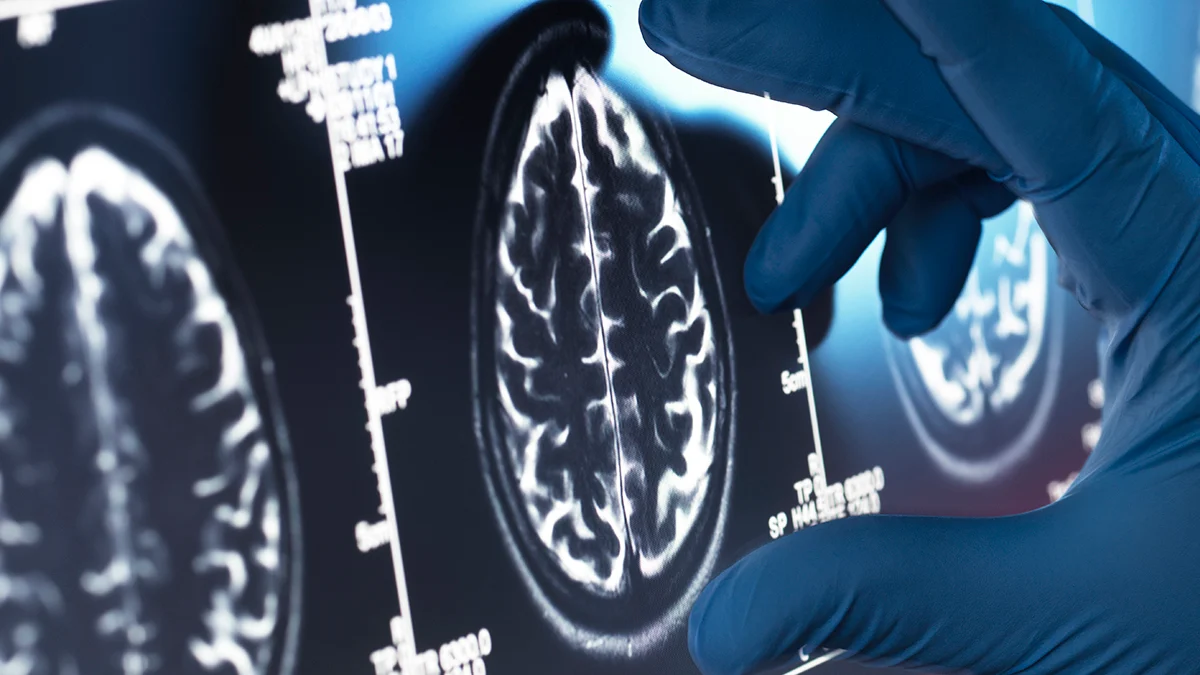 Much-Hyped Alzheimer’s Drugs Show No Meaningful Benefit, Major Review Finds : ScienceAlert