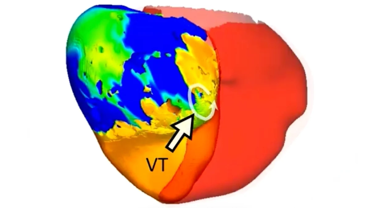 Doctors Treated a Deadly Heart Rhythm With Help From a Digital Twin : ScienceAlert