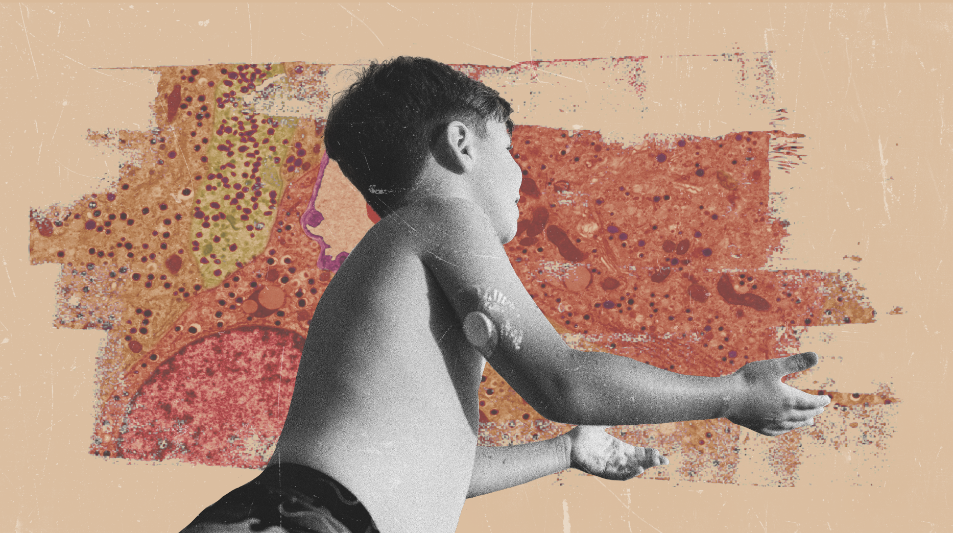 ‘A cure on the horizon’: Are we finally close to ending type 1 diabetes?