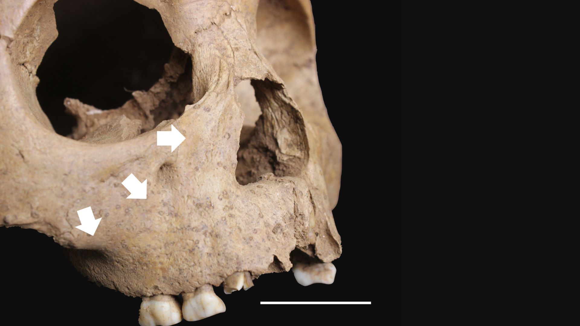 The remains of children from ancient Vietnam may challenge theories about origin of syphilis
