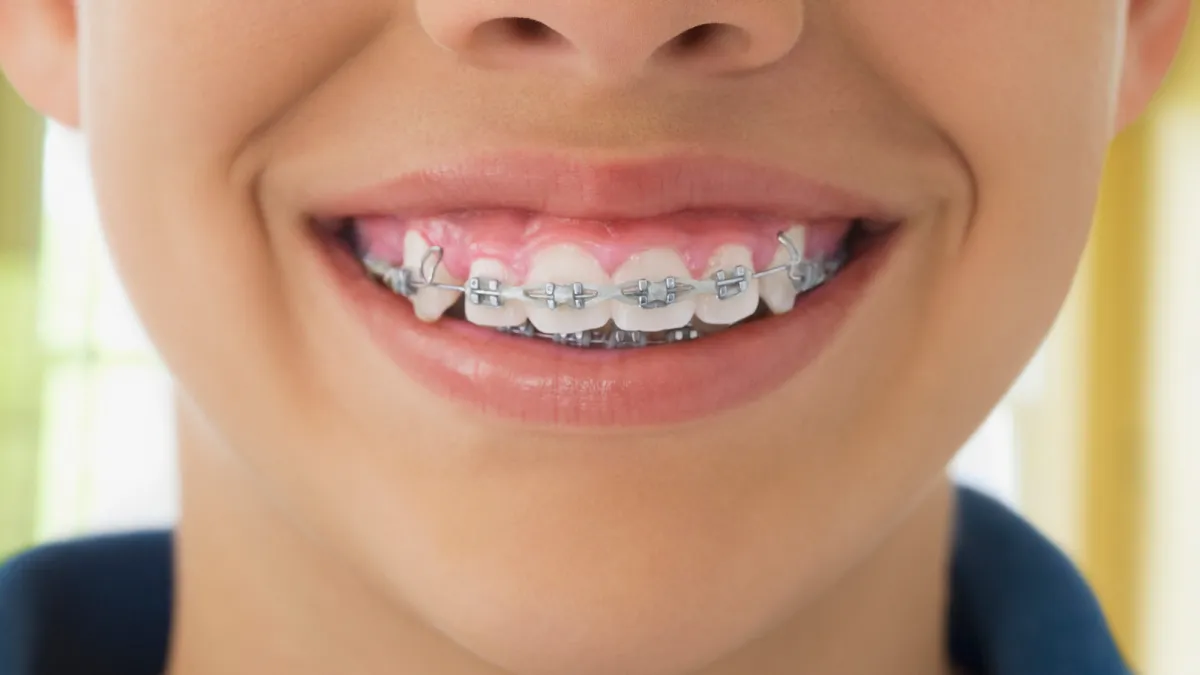 Ancient humans didn’t need braces. So why do we?