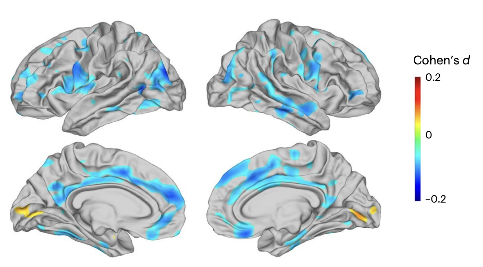 Large MRI analysis uncovers brain-region thinning tied to depression